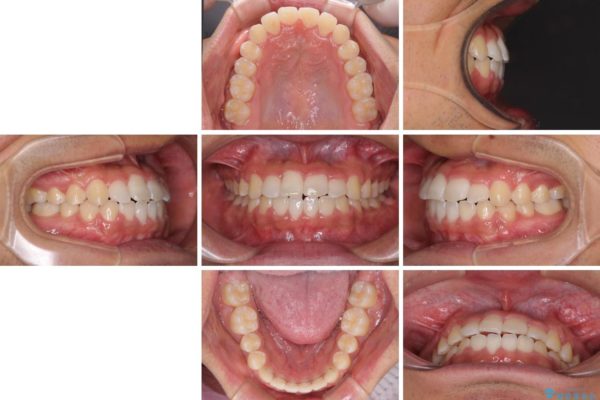 美容歯科でも断られた　著しい前歯のクロスバイトをワイヤー矯正で改善 治療後画像