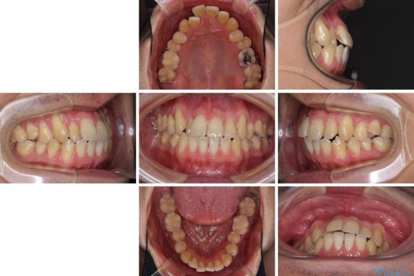 インビザラインによる矯正歯科治療と前歯の根面被覆 治療前画像