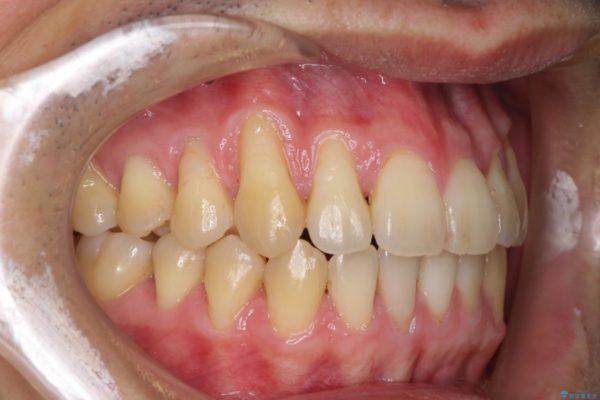 インビザラインによる矯正歯科治療と前歯の根面被覆 治療前画像