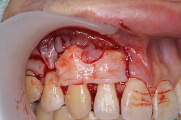 インビザラインによる矯正歯科治療と前歯の根面被覆 治療後画像