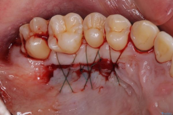 インビザラインによる矯正歯科治療と前歯の根面被覆 治療後画像
