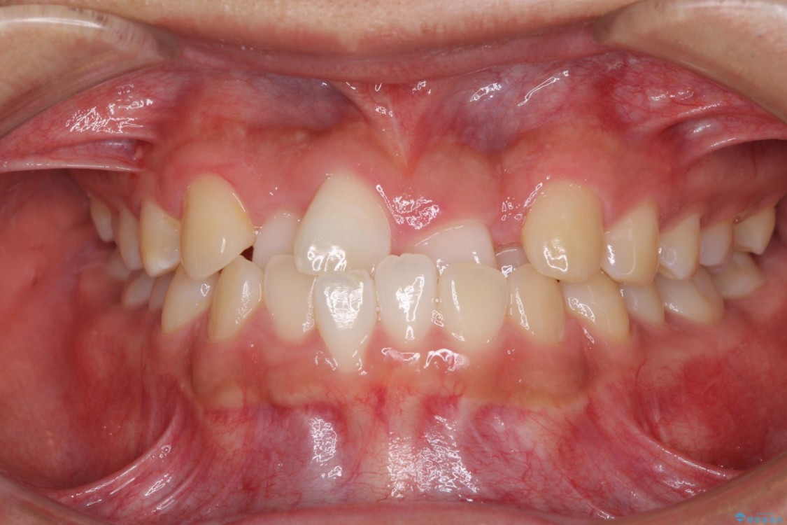 美容歯科でも断られた　著しい前歯のクロスバイトをワイヤー矯正で改善 治療前