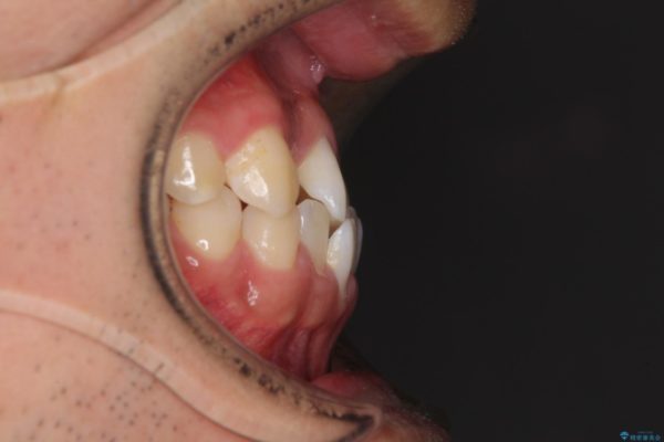 美容歯科でも断られた　著しい前歯のクロスバイトをワイヤー矯正で改善 治療前画像