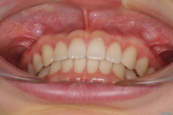 インビザラインによるすきっ歯の治療 治療後画像