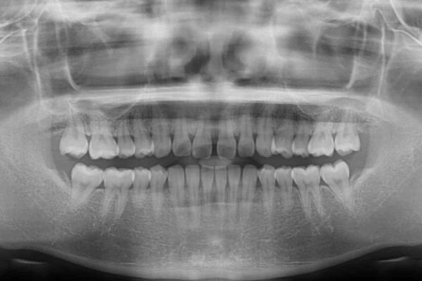 インビザラインによるすきっ歯の治療 治療前画像