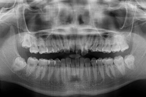美容歯科でも断られた　著しい前歯のクロスバイトをワイヤー矯正で改善 治療前画像