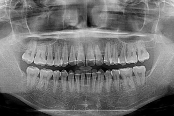 前歯のクロスバイト　インビザラインによる矯正治療 治療後画像