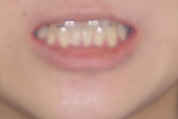 矯正治療とインプラント治療による欠損部と残存乳歯の改善 治療前画像