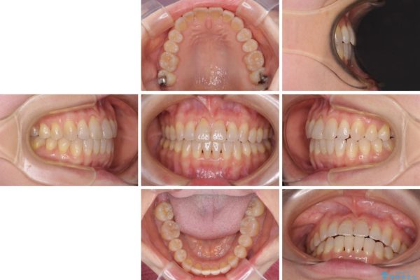 前歯の叢生と切端咬合　インビザラインによる矯正治療 治療後画像
