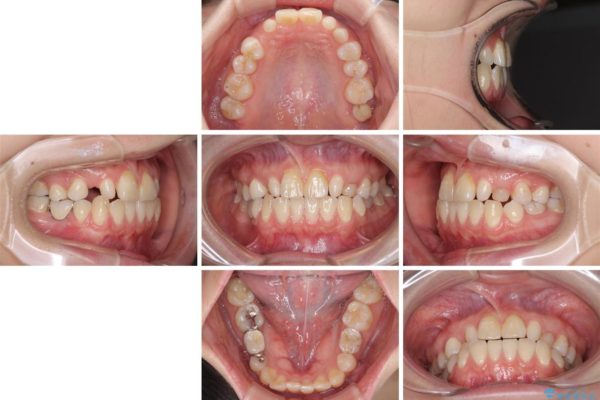 矯正治療とインプラント治療による欠損部と残存乳歯の改善 治療前画像