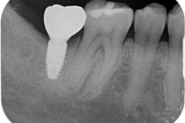 抜歯後放置されたままの奥歯　ストローマンインプラントによる欠損補綴治療 治療後画像