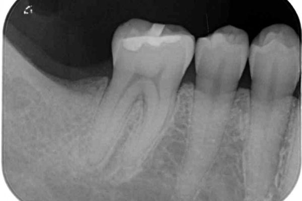 抜歯後放置されたままの奥歯　ストローマンインプラントによる欠損補綴治療 治療前画像