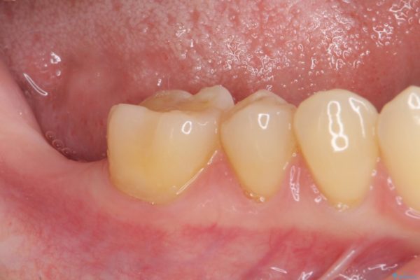 抜歯後放置されたままの奥歯　ストローマンインプラントによる欠損補綴治療 治療前画像