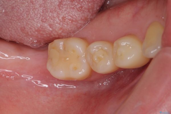 抜歯後放置されたままの奥歯　ストローマンインプラントによる欠損補綴治療 ビフォー