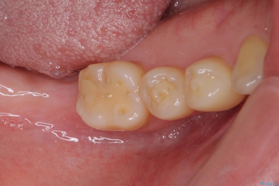 抜歯後放置されたままの奥歯　ストローマンインプラントによる欠損補綴治療 治療前