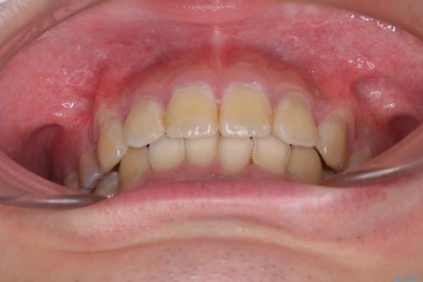 口元の閉じにくさとガタつきの解消　ワイヤー装置による抜歯矯正 治療後画像