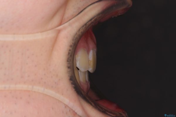 口元の閉じにくさとガタつきの解消　ワイヤー装置による抜歯矯正 治療後画像