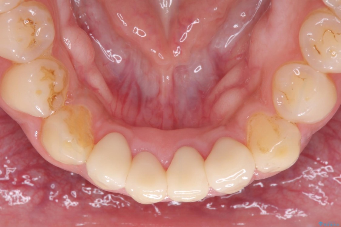 すり減ってしまった前歯 セラミッククラウンで自然な形に 東京駅前しらゆり歯科 東京駅八重洲口 日本橋駅