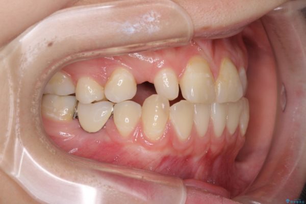 矯正治療とインプラント治療による欠損部と残存乳歯の改善 ビフォー