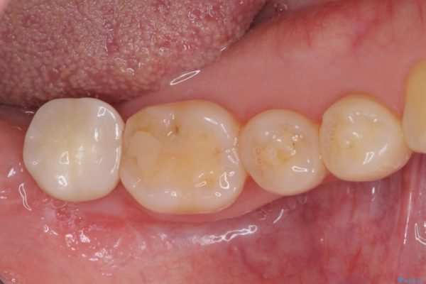 抜歯後放置されたままの奥歯　ストローマンインプラントによる欠損補綴治療 治療後画像