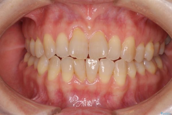 前歯の叢生と切端咬合　インビザラインによる矯正治療 治療前画像