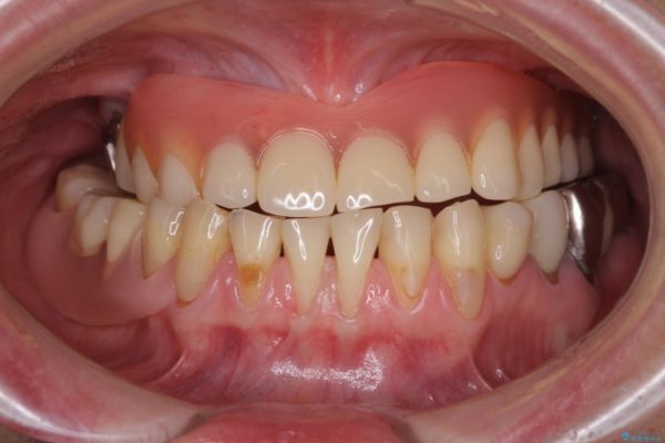 咬合による前歯の歯肉退縮　歯肉移植による根面被覆 治療前画像