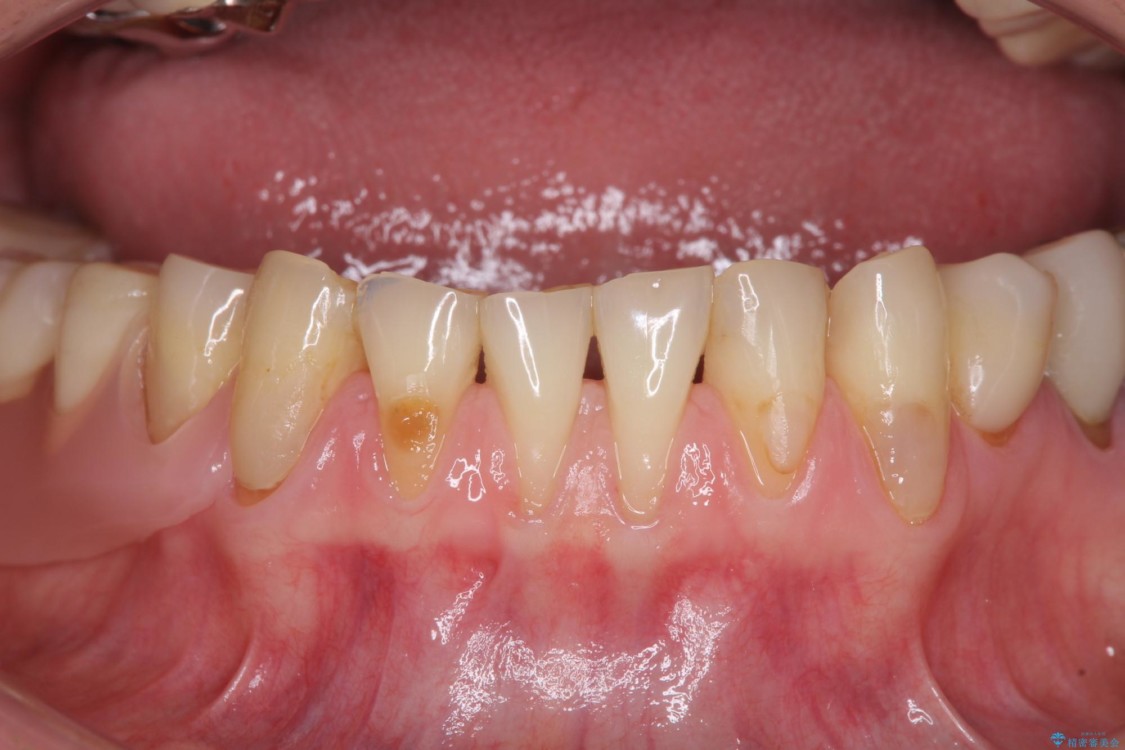 咬合による前歯の歯肉退縮　歯肉移植による根面被覆 治療前