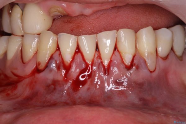 咬合による前歯の歯肉退縮　歯肉移植による根面被覆 治療前画像