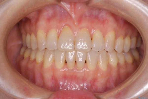前歯の叢生と切端咬合　インビザラインによる矯正治療 治療後画像