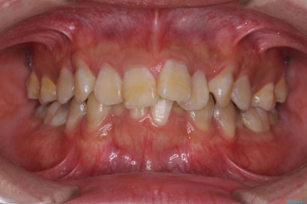 口元の閉じにくさとガタつきの解消　ワイヤー装置による抜歯矯正 治療前画像