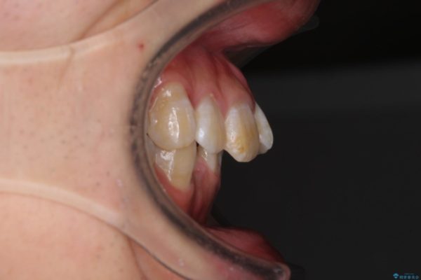 口元の閉じにくさとガタつきの解消　ワイヤー装置による抜歯矯正 ビフォー