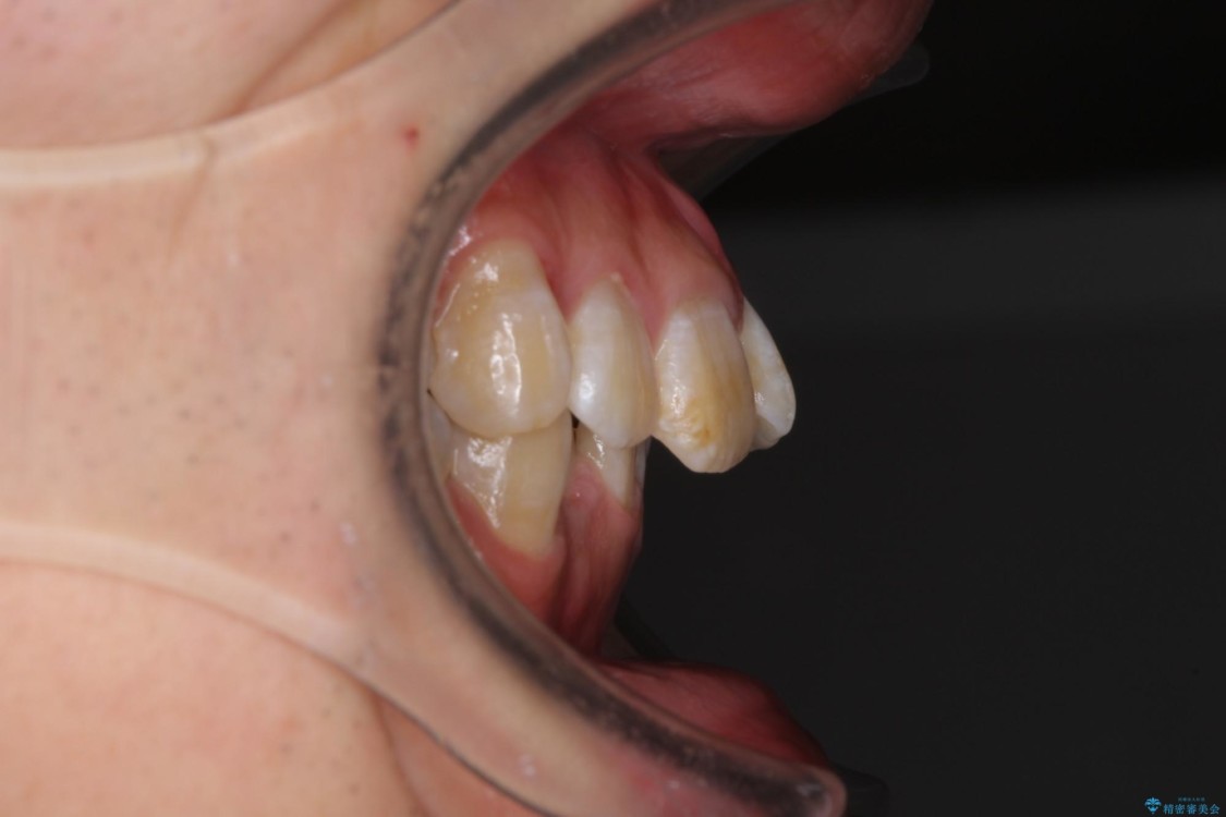 口元の閉じにくさとガタつきの解消　ワイヤー装置による抜歯矯正 治療前