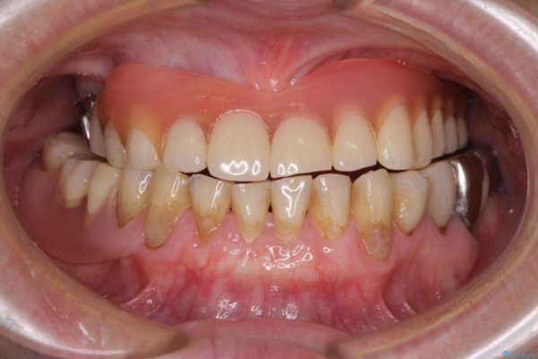 咬合による前歯の歯肉退縮　歯肉移植による根面被覆 治療後画像
