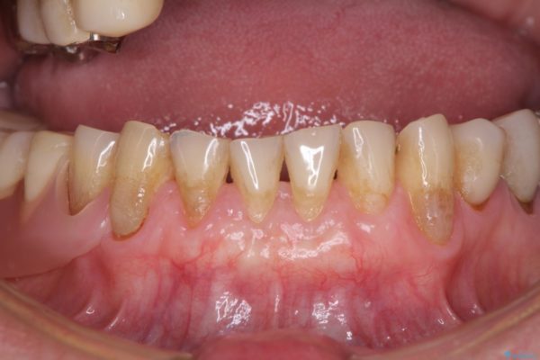 咬合による前歯の歯肉退縮　歯肉移植による根面被覆 アフター