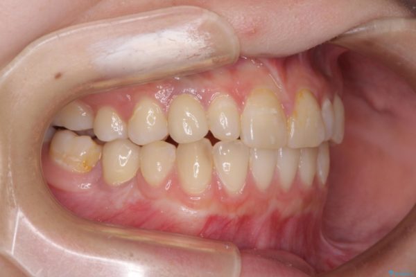 矯正治療とインプラント治療による欠損部と残存乳歯の改善 治療後画像