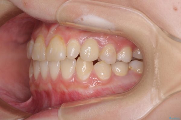 矯正治療とインプラント治療による欠損部と残存乳歯の改善 治療後画像