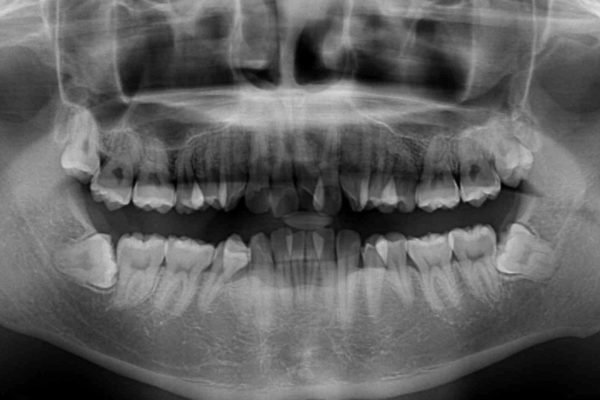 口元の閉じにくさとガタつきの解消　ワイヤー装置による抜歯矯正 治療前画像