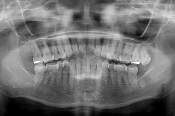 前歯の叢生と切端咬合　インビザラインによる矯正治療 治療前画像