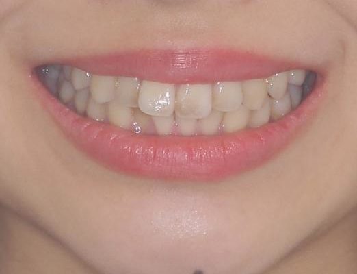 前歯の気になるデコボコをインビザラインで矯正治療 治療前画像