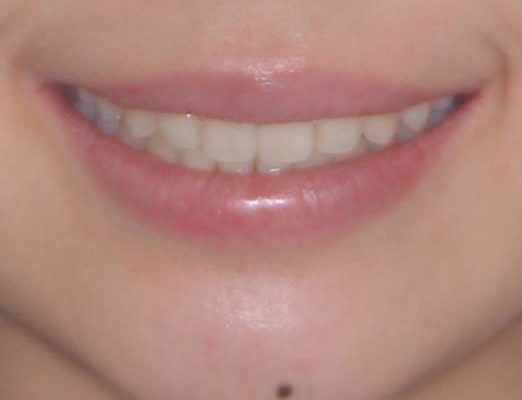 前歯の気になるデコボコをインビザラインで矯正治療 治療後画像