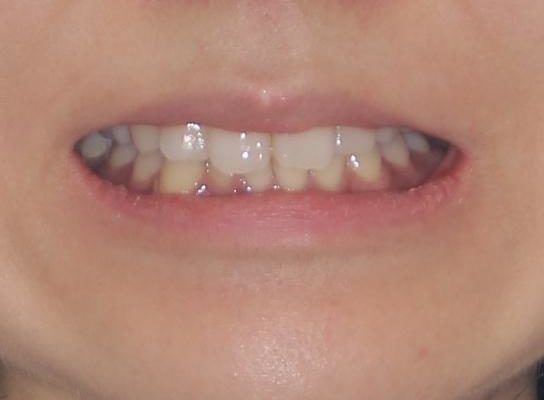 抜歯矯正の後戻り　インビザラインによる再矯正治療 治療前画像