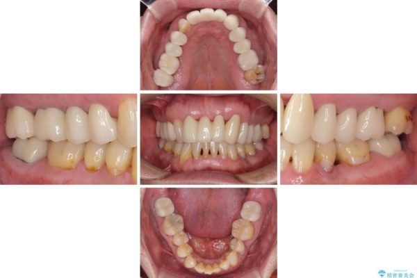 矯正治療と歯周外科処置を併用した審美歯科治療 治療後画像