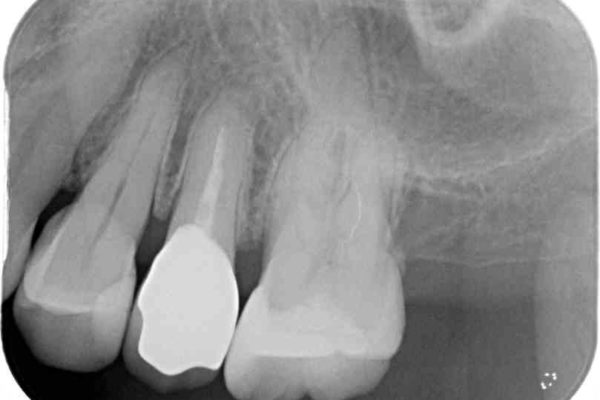 歯肉退縮で歯根が見えるようになってしまった　オールセラミッククラウンによる審美歯科治療 治療後画像