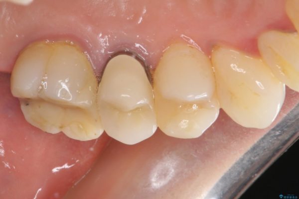 歯肉退縮で歯根が見えるようになってしまった　オールセラミッククラウンによる審美歯科治療 治療前画像