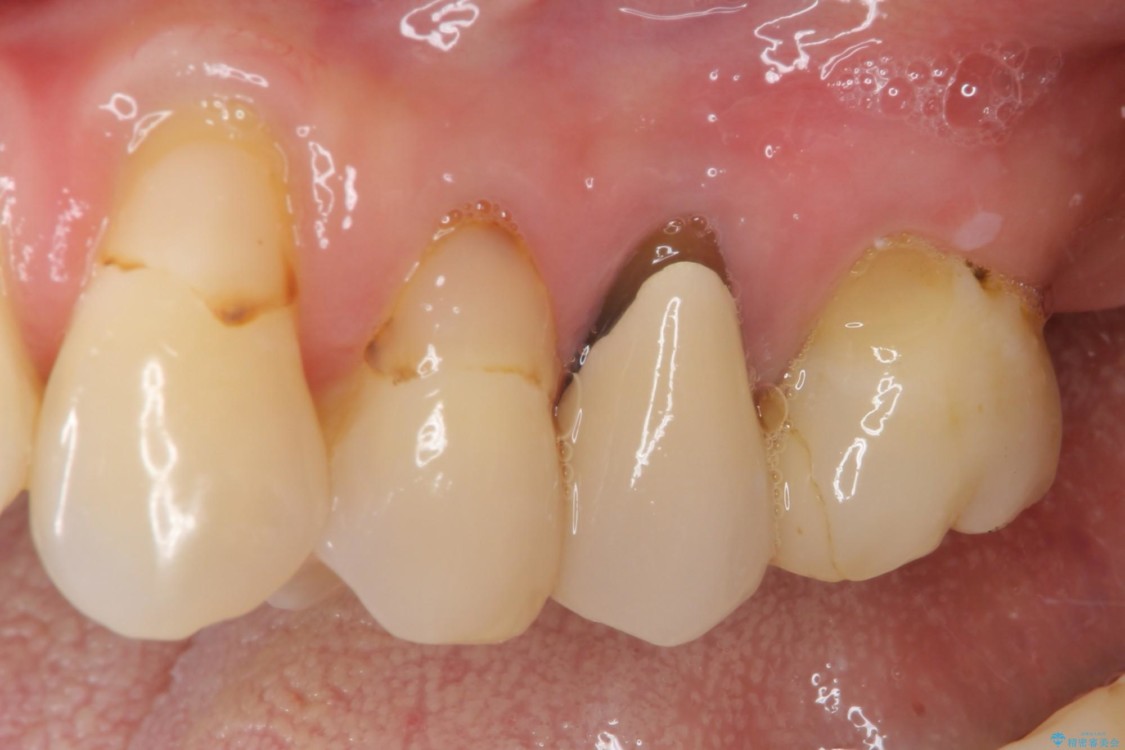 歯肉退縮で歯根が見えるようになってしまった　オールセラミッククラウンによる審美歯科治療 治療前