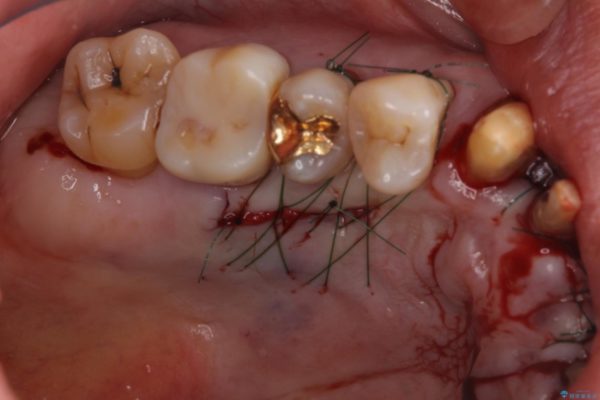 矯正治療と歯周外科処置を併用した審美歯科治療 治療前画像