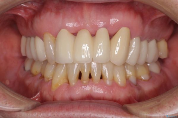 矯正治療と歯周外科処置を併用した審美歯科治療 アフター