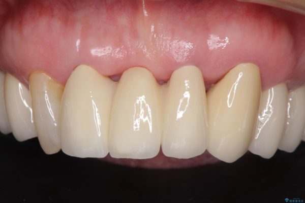 矯正治療と歯周外科処置を併用した審美歯科治療 治療後画像