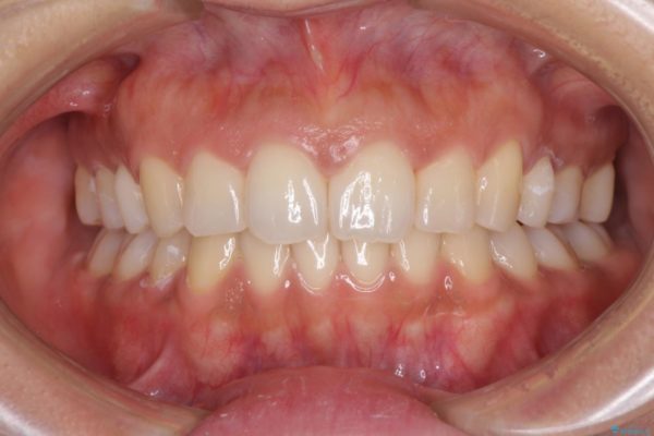 抜歯矯正の後戻り　インビザラインによる再矯正治療 治療後画像