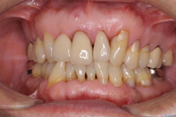 矯正治療と歯周外科処置を併用した審美歯科治療 ビフォー